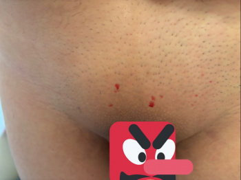 【画像】アソコの毛剃ったら血出てきた?ｗｗｗｗｗｗの画像