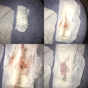 羽根側にも少し漏れた跡が伺える観察された使用済み経血ナプキンの画像