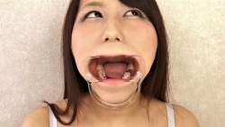 【口腔フェチ動画】女性に開口器を付けてインレーや銀歯、のどちんこを観察の画像