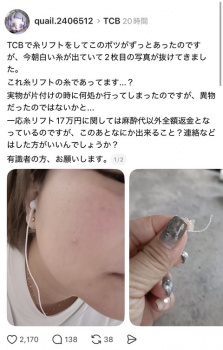 整形女子「糸リフトした後に糸リフトの糸？が出てきた...」怖すぎると話題にの画像