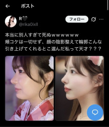 【画像】美女「顔の脂肪吸引して垢抜けた～！」の画像