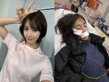 AV女優の及川うみが顔13針縫う大怪我をしてしまうの画像